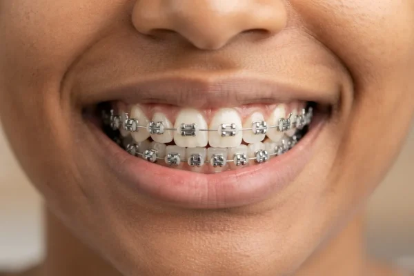 How Braces Move Teeth: The Science, Imaging & Retainers Behind Lasting Results