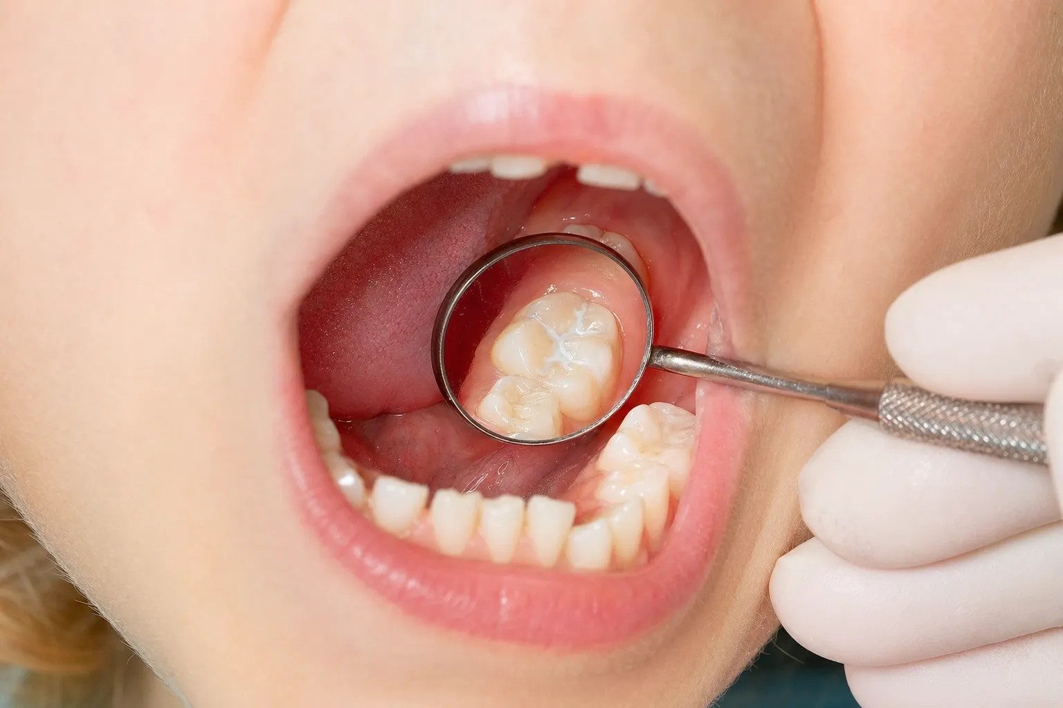Close-up of a child's open mouth showing healthy back molars, with a dental professional gently pointing to a recently sealed molar using a dental mirror. The image is clean, clinical, and reassuring — showing the natural appearance of sealants on teeth.