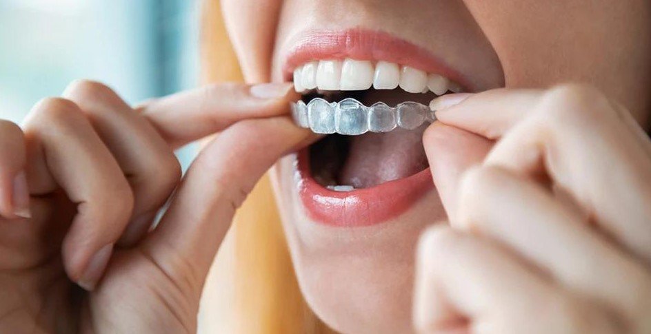 What Is Invisalign Sunbury? A Complete Guide to Clear Aligner Treatment
