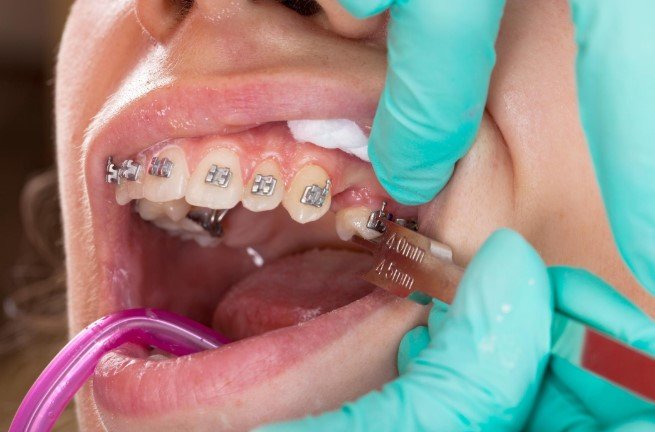 Orthodontics Near Me: A Complete Guide to Modern Teeth Straightening Treatments