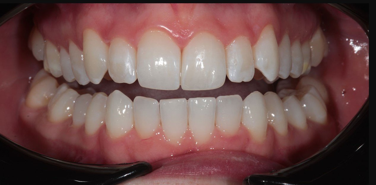 Invisalign Aligner Orthodontics Sunbury: A Complete Guide to Modern Teeth Alignment