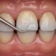 Composite Resin Bonding Sunbury: A Complete Guide to Modern Cosmetic Dental Treatment