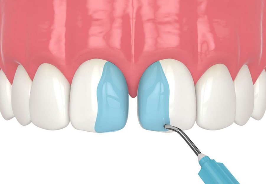 Composite Resin Bonding Sunbury: A Complete Guide to Modern Cosmetic Dental Treatment