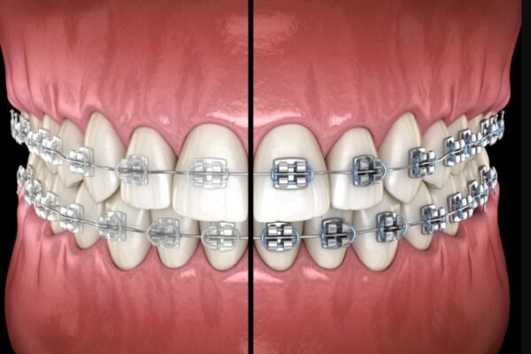 Orthodontic Wax: A Complete Guide for Braces Comfort and Oral Health