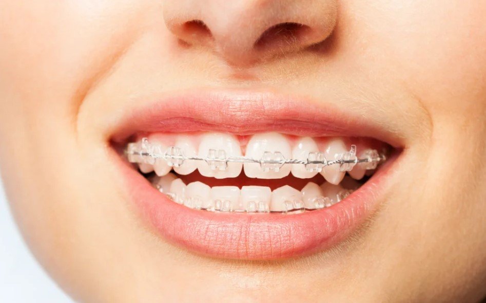 Cost Orthodontic Braces: A Complete Guide to Understanding Treatment Costs and Options