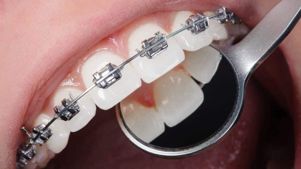 Whether researching orthodontic treatment in Sunbury, Diggers Rest, Greenvale, Bulla, Wildwood, Craigieburn, Gisborne, Riddells Creek, Melton, Taylors Lakes, or Keilor, taking time to understand the treatment process can help create realistic expectations.