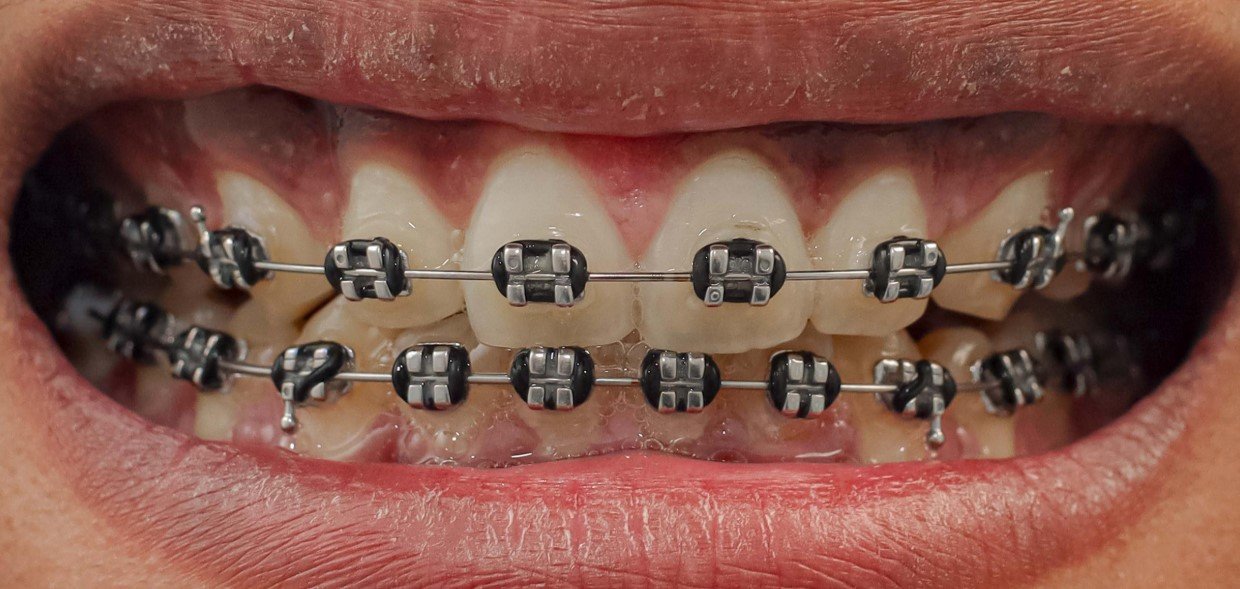 SmileBliss Orthodontics Sunbury | Braces & Aligners Guide