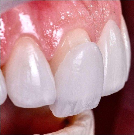 Veneers Are Custom-Crafted Shells That Create a Brighter, More Attractive Smile: The Complete Guide to Transforming Your Smile in Sunbury