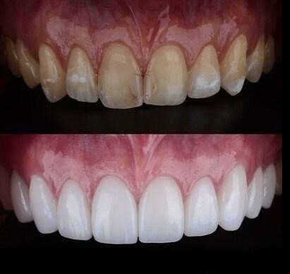 Veneers Are Custom-Crafted Shells That Create a Brighter, More Attractive Smile: The Complete Guide to Transforming Your Smile in Sunbury