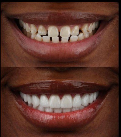 Veneers Are Custom-Crafted Shells That Create a Brighter, More Attractive Smile: The Complete Guide to Transforming Your Smile in Sunbury