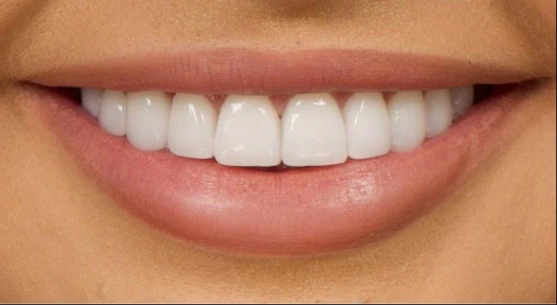 Veneers Are Custom-Crafted Shells That Create a Brighter, More Attractive Smile: The Complete Guide to Transforming Your Smile in Sunbury