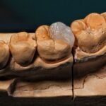 Myobrace vs Braces | Which Orthodontic Treatment Is Best for Your Smile in Sunbury?