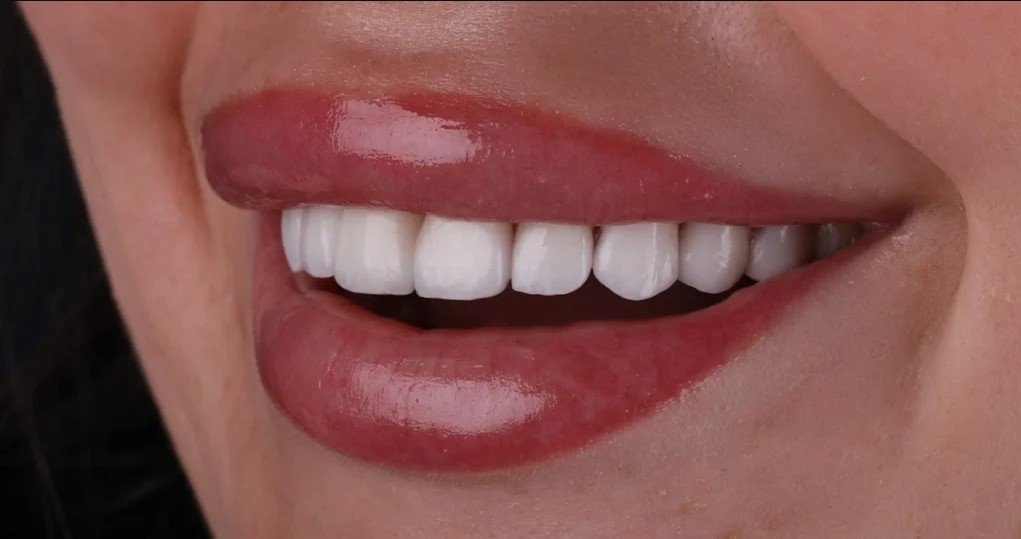 Tooth Porcelain Veneers Sunbury | Complete Smile Makeover Guide