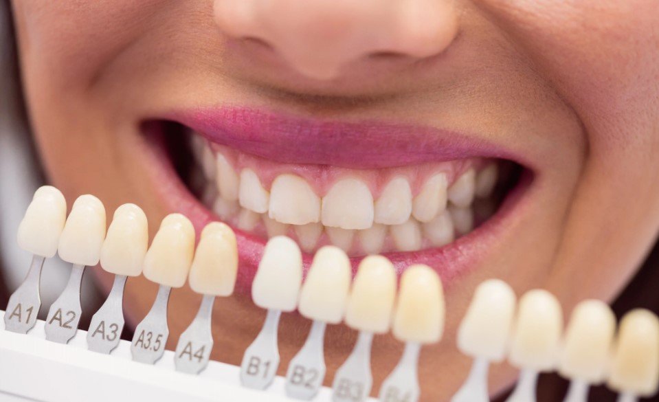 Tooth Porcelain Veneers: The Complete Guide to a Natural Smile Makeover in Sunbury