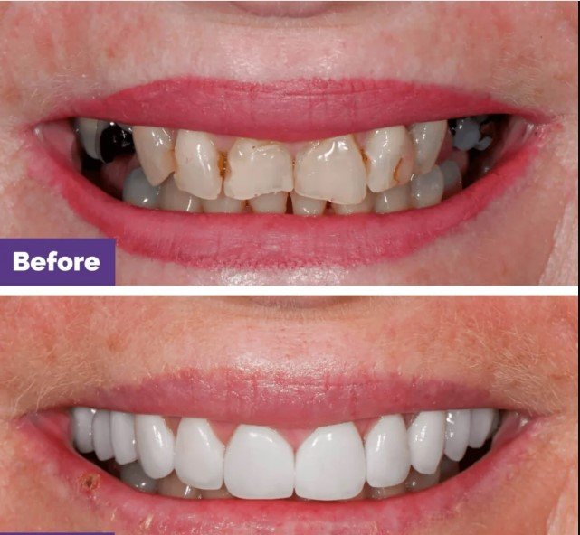 dental veneers What Is a Cosmetic Sunbury Dentist Called? Complete Smile Guide