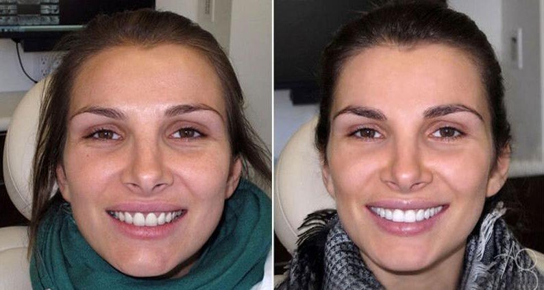 dental veneers What Is a Cosmetic Sunbury Dentist Called? Complete Smile Guide
