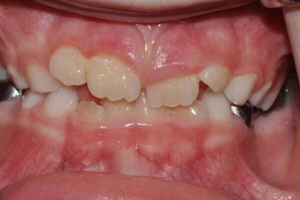 Myobrace vs Braces | Which Orthodontic Treatment Is Best for You ?
