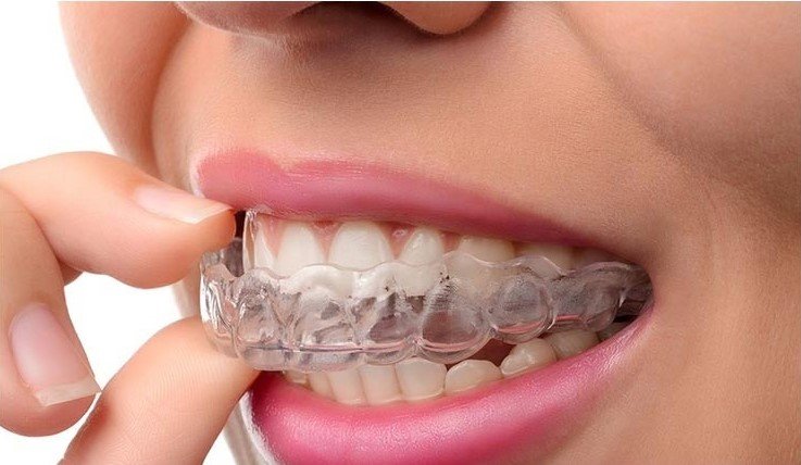 Braces vs Aligners | Which Is Better for Your Smile