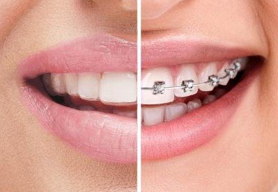 Braces vs Aligners | Which Is Better for Your Smile