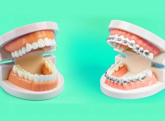 Braces vs Aligners | Which Is Better for Your Smile