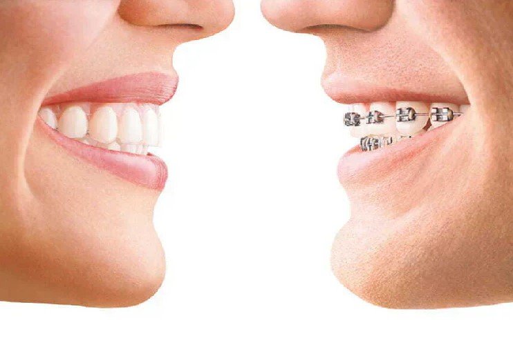 Braces vs Aligners | Which Is Better for Your Smile