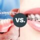 Braces vs Aligners | Which Is Better for Your Smile
