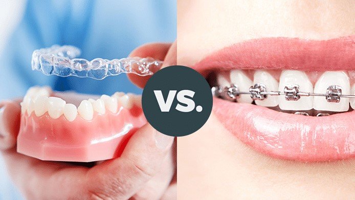 Braces vs Aligners | Which Is Better for Your Smile