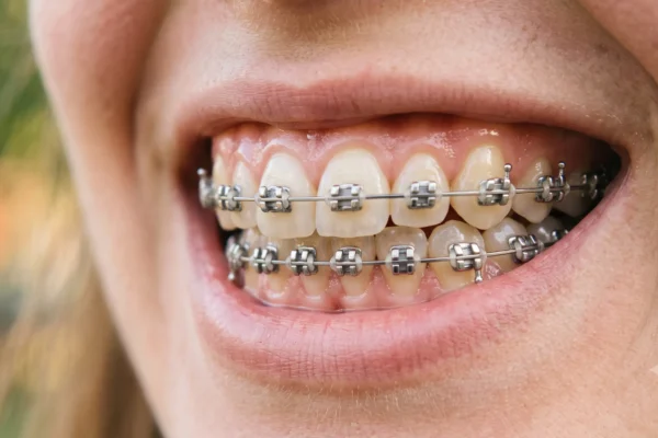 Braces Aintree: Cost Guide for Metal & Fixed Orthodontics