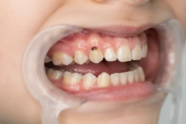 Black Spot on Baby Tooth: Cavity or Just Staining?