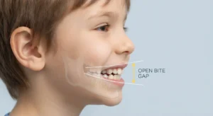open bite children thumb sucking front teeth gap