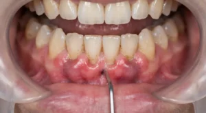 bad breath gum disease inflamed gumline
