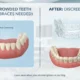 Discreet Options Crowded Teeth